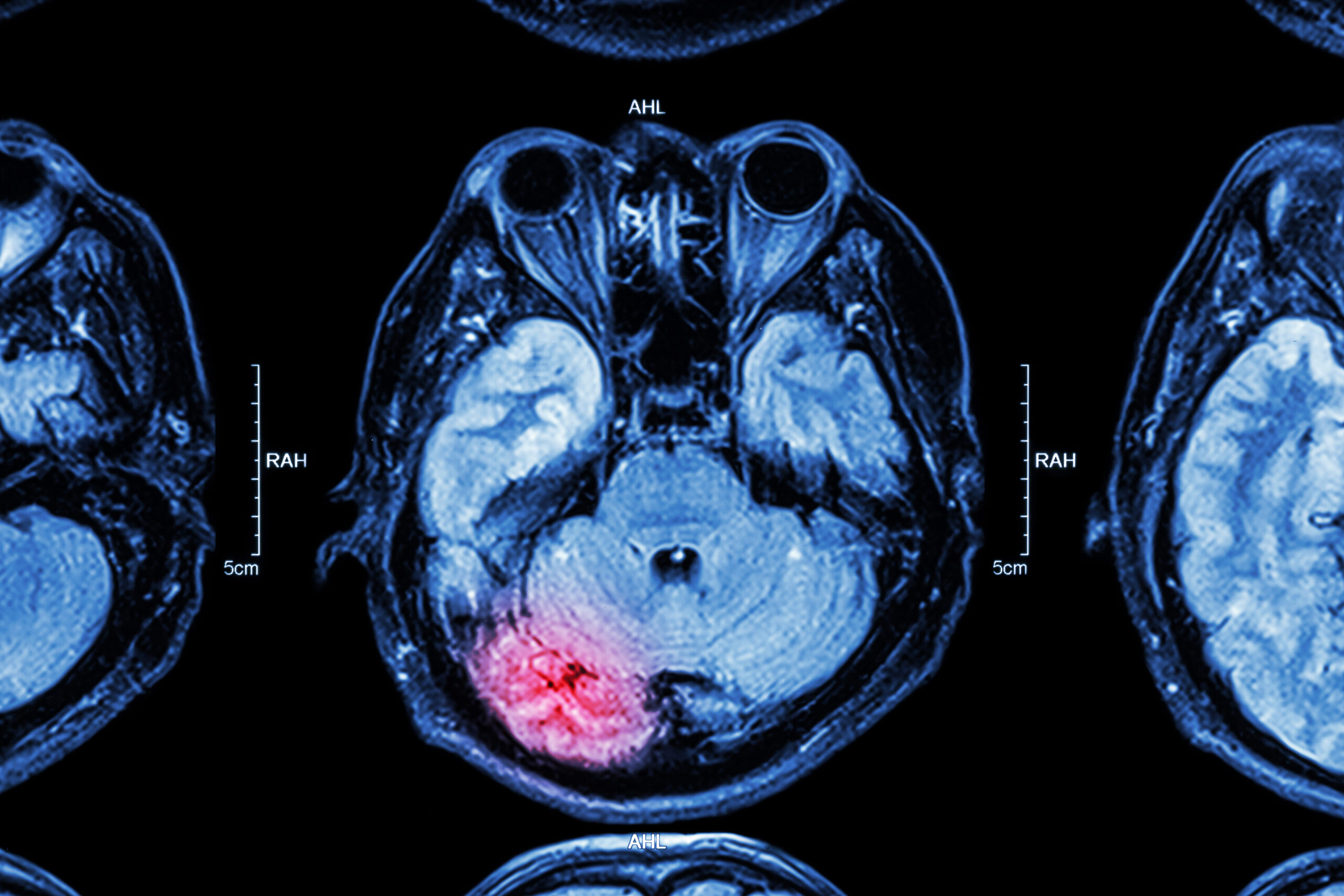 MRI of brain : traumatic brain injury scan 